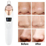 5-in-1 Rechargeable Blackhead Remover – Deep Cleanse & Radiant Skin