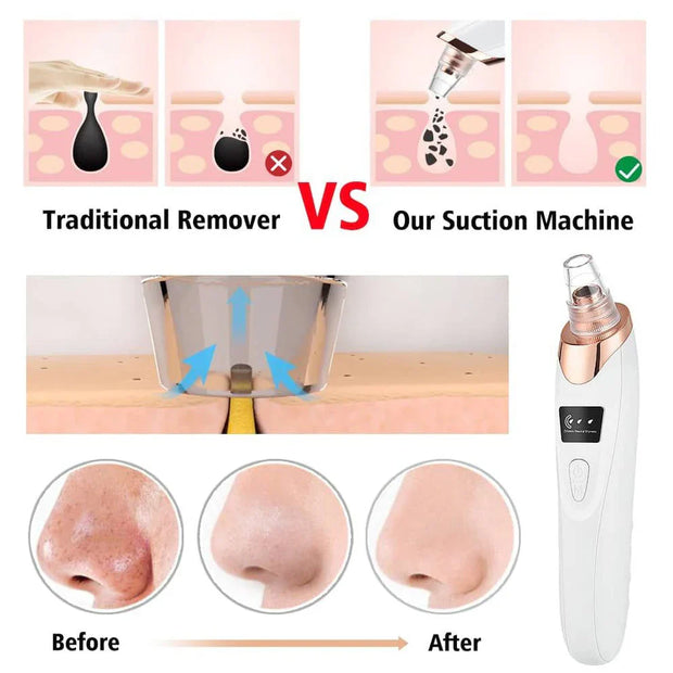 5-in-1 Rechargeable Blackhead Remover – Deep Cleanse & Radiant Skin